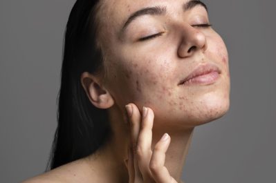 portrait-young-woman-being-confident-with-acne